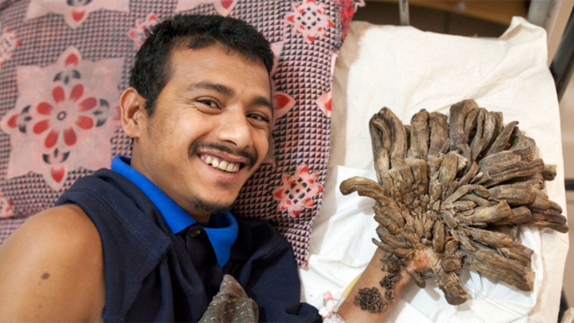 Bangladeshi 'Tree Man' begs for hands to be amputated to relieve pain, report says